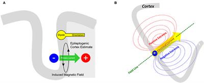 Practical Fundamentals of Clinical MEG Interpretation in Epilepsy